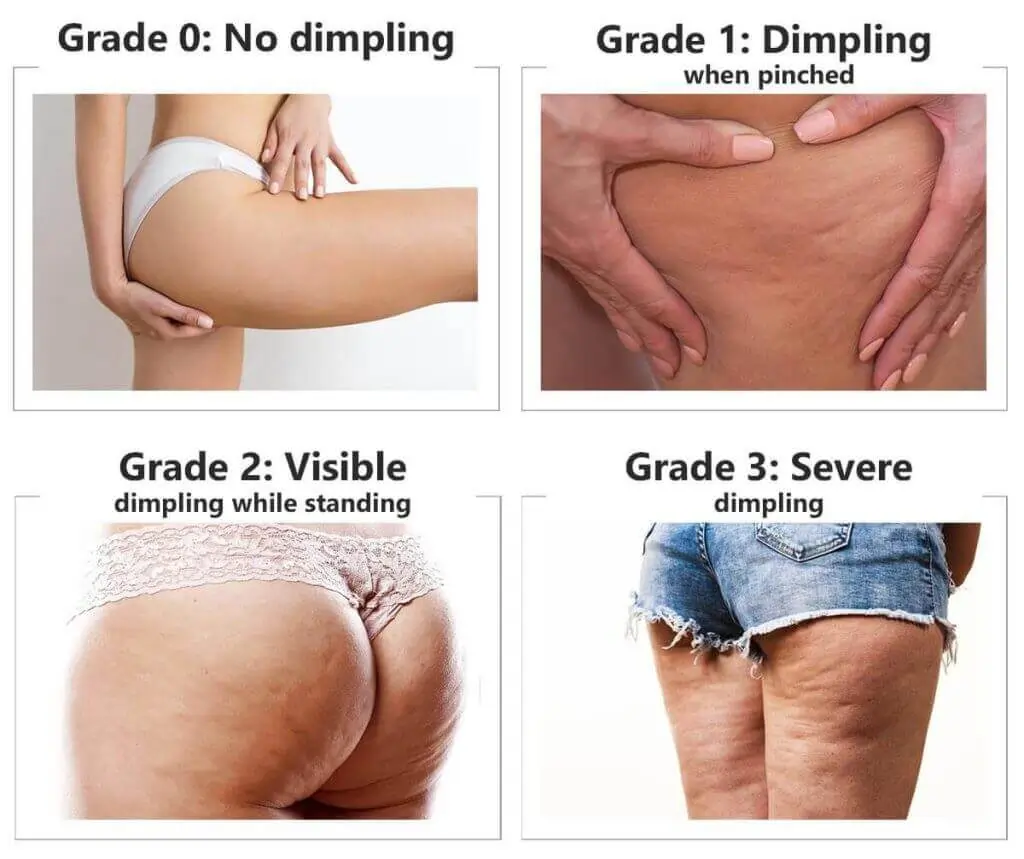 Representation of the stages of cellulite development Bognor Regis